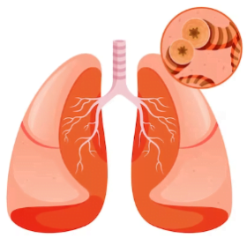 Asthma
