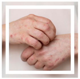 Eczema