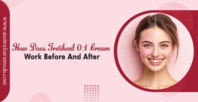How Does Tretiheal Cream 0.1 Work Before And After?
