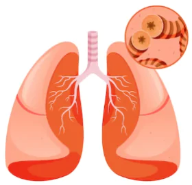 Asthma