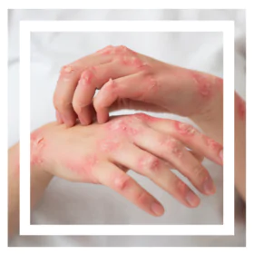 Dermatitis