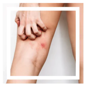 Chafing